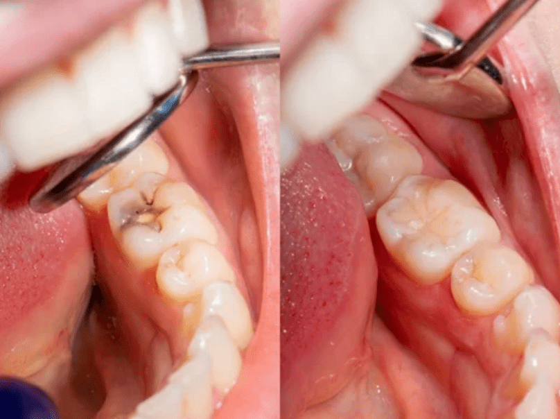 Best Tips to Avoid Cavities