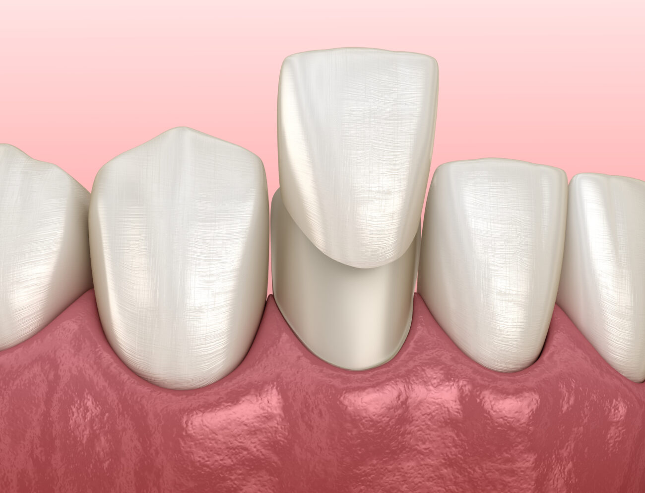 Cosmetic dentistry in Flower Mound, TX, can help fix a variety of imperfections in your smile