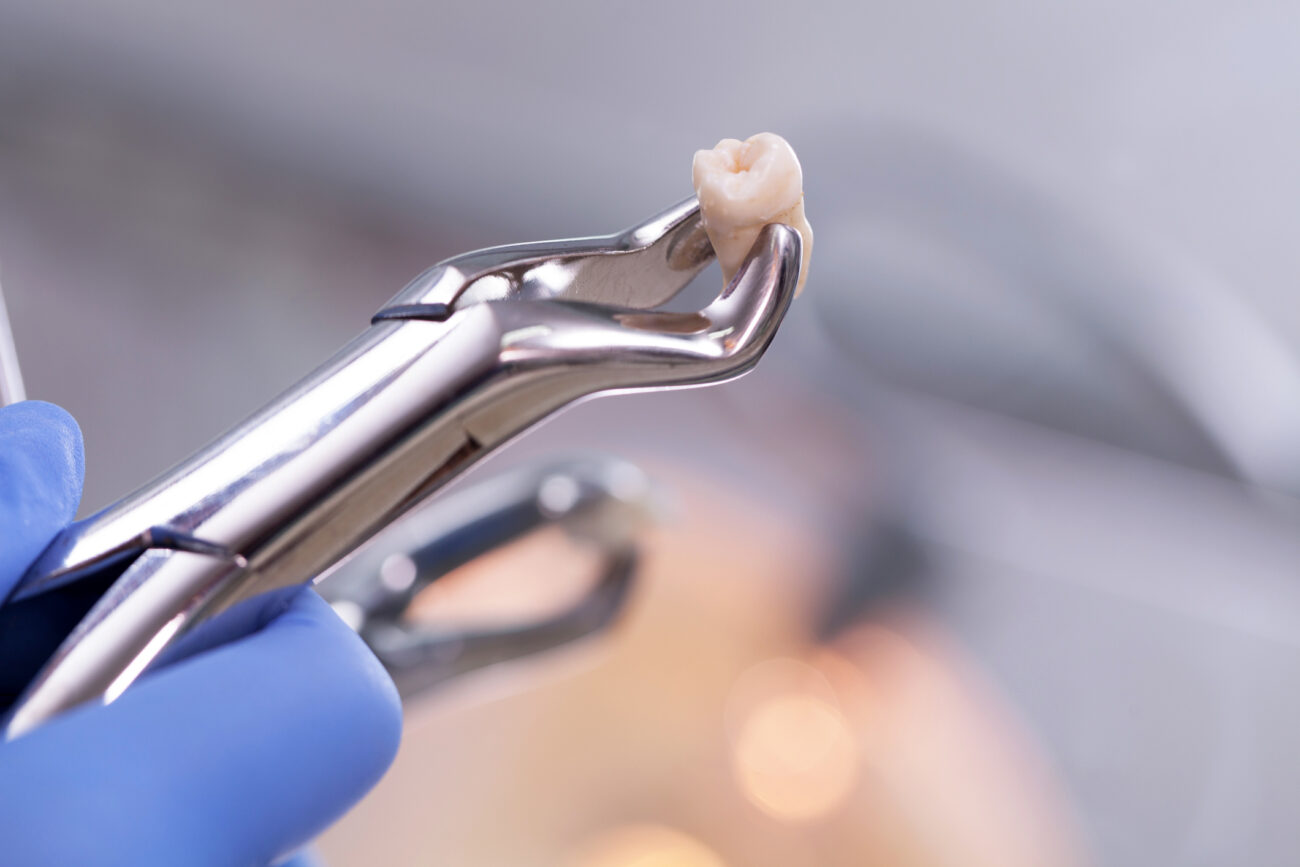 You may need a tooth extraction in Flower Mound, TX, if you have decay, damage, or tooth crowding.